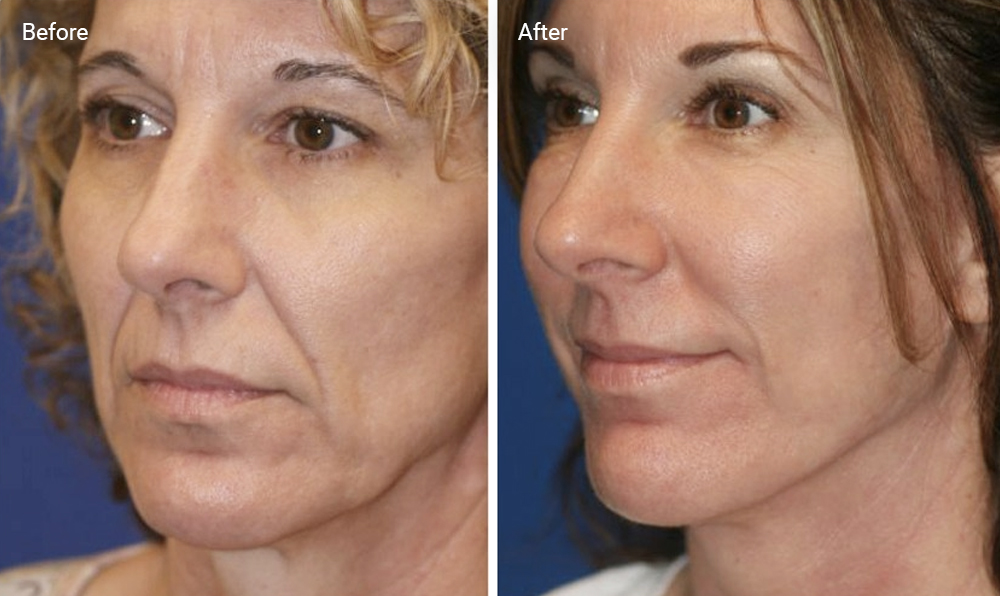 Radio Frequency Skin Tightening: Does It Work And Is It Safe