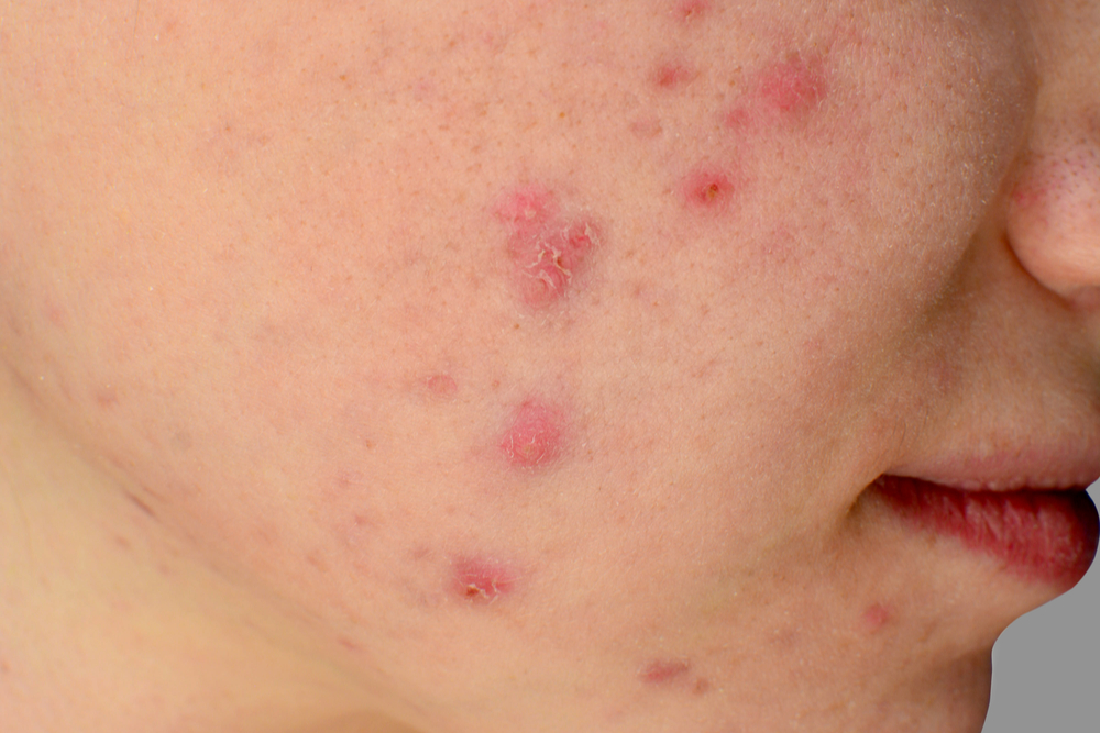 Types Of Acne Differences Treatments And Prevention