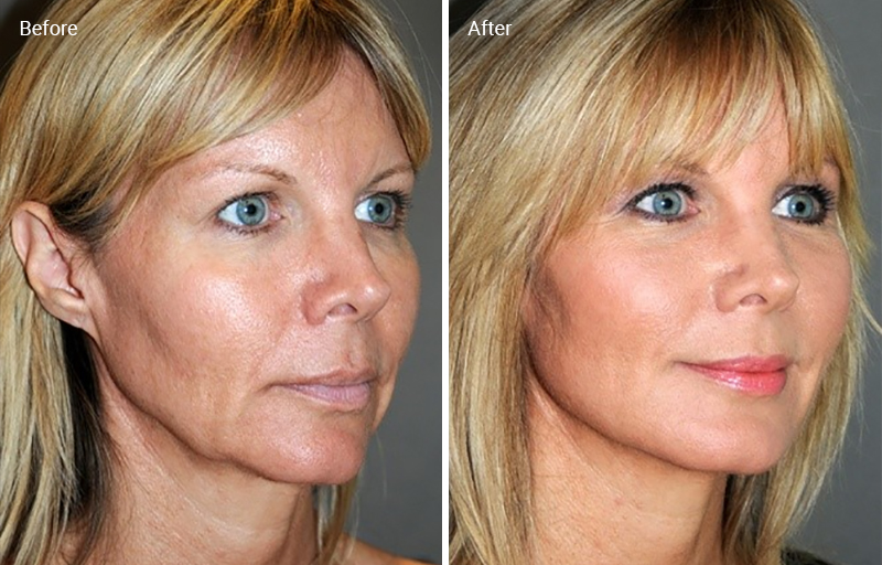 Laser Skin Tightening: How It Works, Results, Risks And Cost