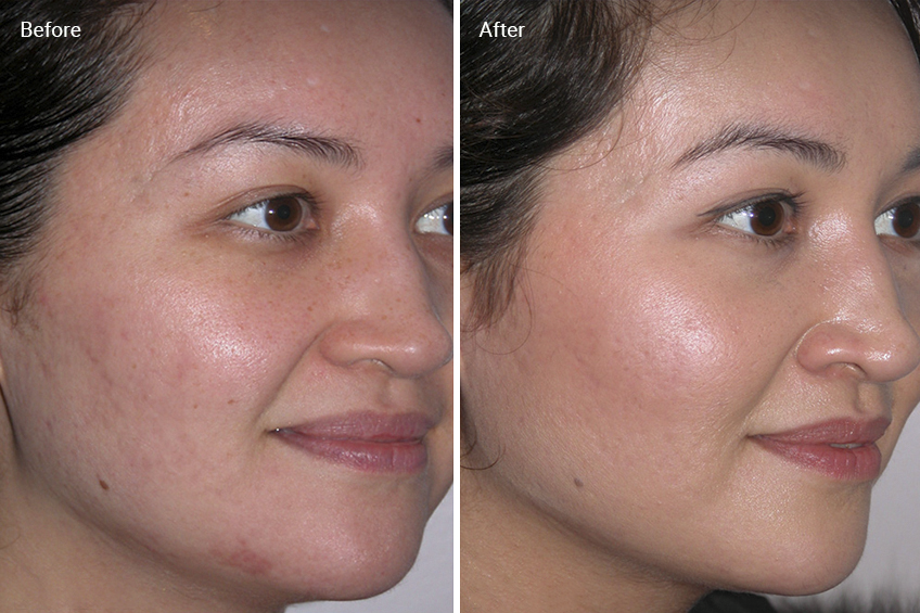 Microdermabrasion: Benefits, Before And Afters, Side Effects, Cost