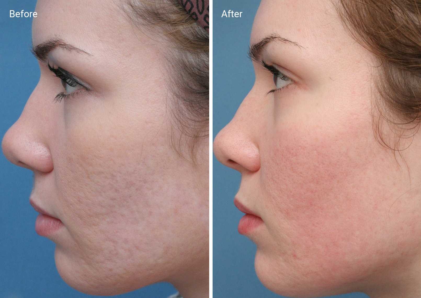 Chemical Peels For Acne Scars: Efficacy, Before And Afters, At-Home Uses