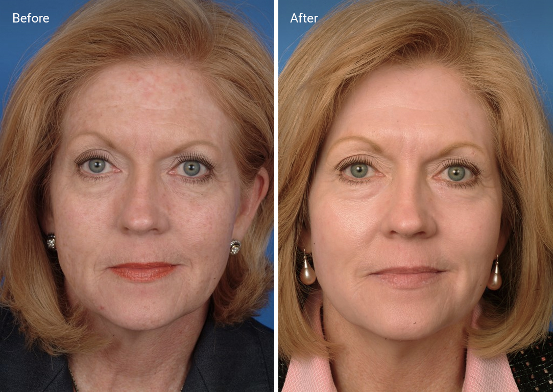 Laser Skin Resurfacing: What It Is, How It Works, Side Effects & Cost