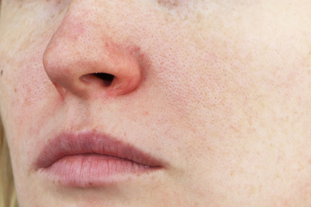 Acne Rosacea: What It Is, Comparison to Acne, Symptoms and Treatments