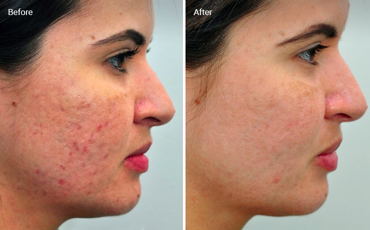 Laser Skin Resurfacing For Acne Scars: Efficacy, Before & Afters, Cost