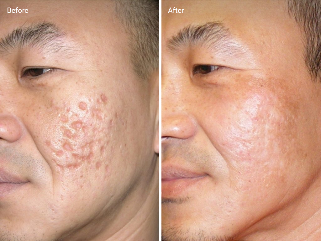 Laser Skin Resurfacing For Acne Scars: Efficacy, Before & Afters, Cost