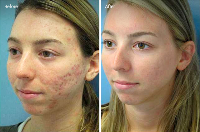 Laser Skin Resurfacing For Acne Scars: Efficacy, Before & Afters, Cost