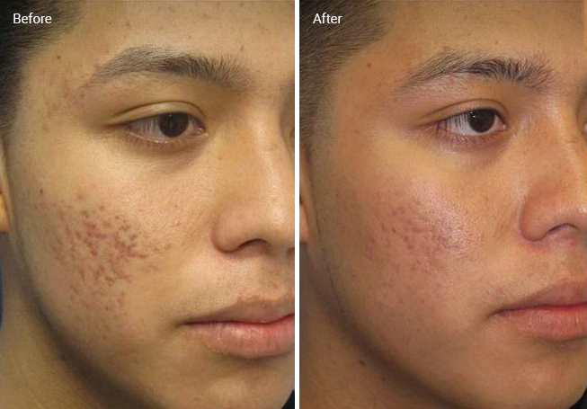 Laser Skin Resurfacing For Acne Scars: Efficacy, Before & Afters, Cost