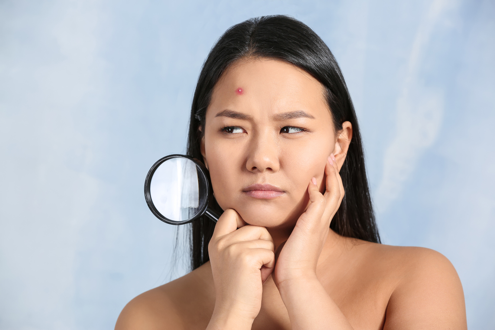 How to Get Rid of Acne Fast Natural Remedies and Treatments