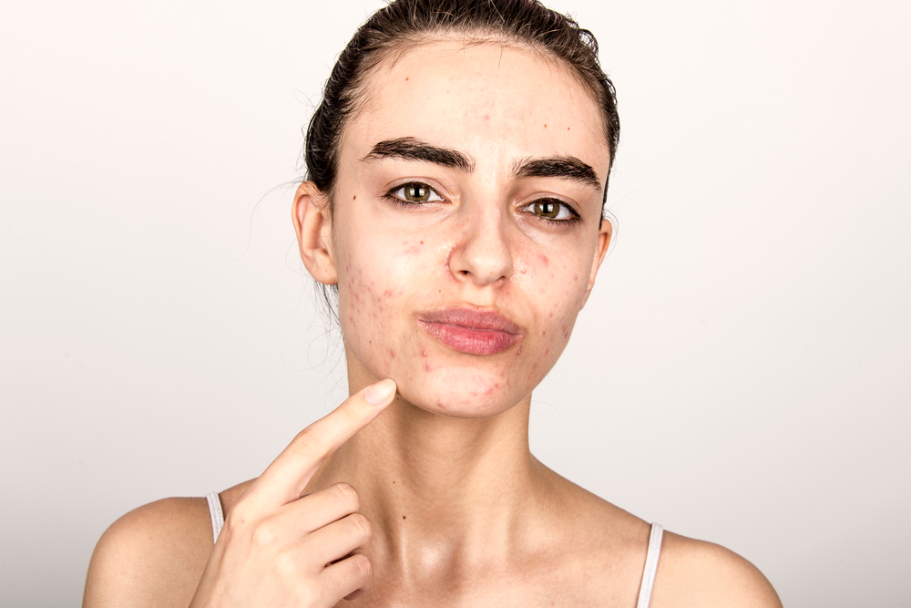 acne-breakouts-around-mouth-causes-treatments-and-more