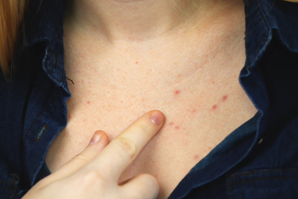 Chest Acne What Causes It And How To Get Rid Of It
