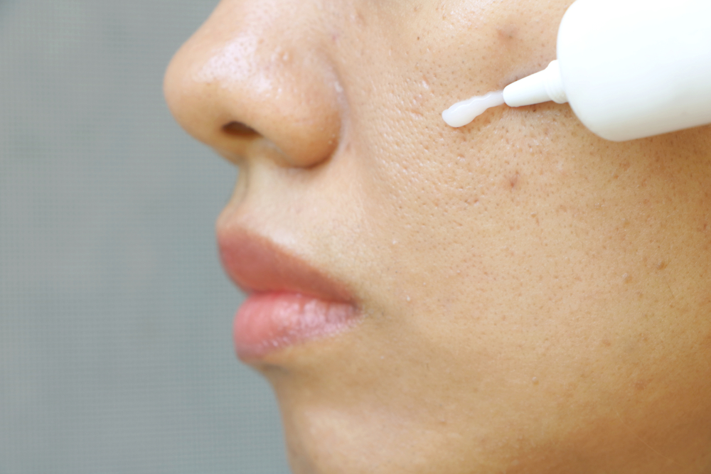 Retinol for Acne How to Use It, Products, Side Effects and More