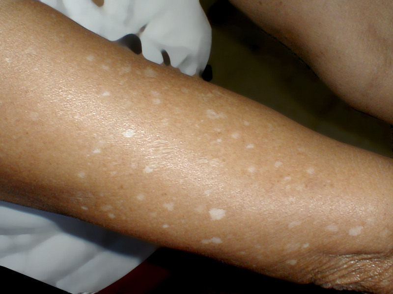 White Spots On Skin After Sun At David Jasmin Blog White Spots On Skin After Sun At David Jasmin Blog