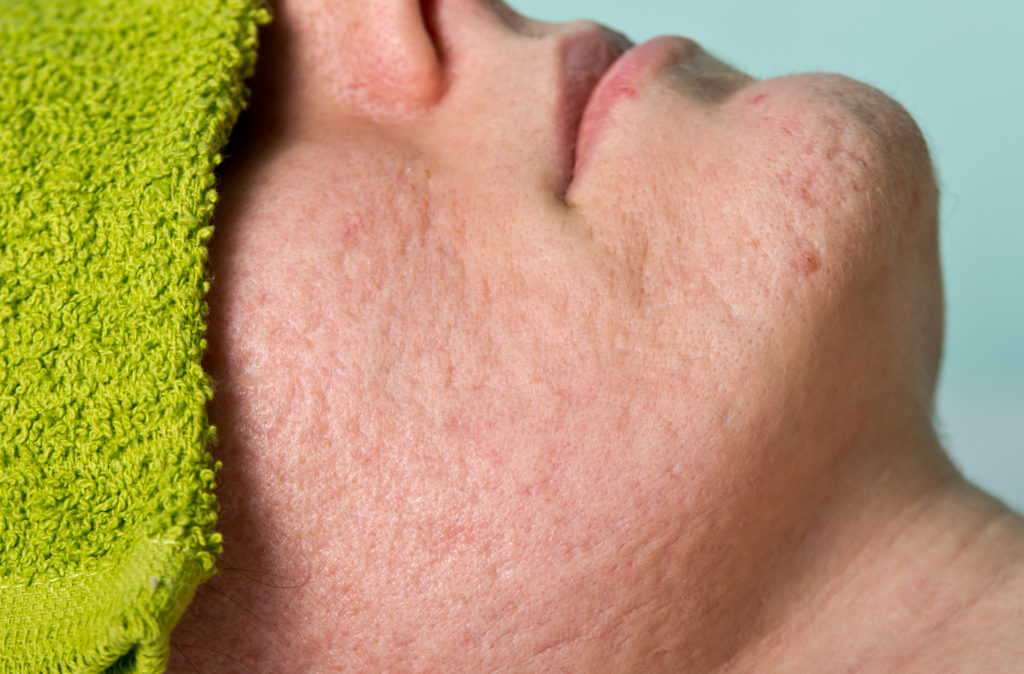 How To Get Rid Of New Acne Scars Fast