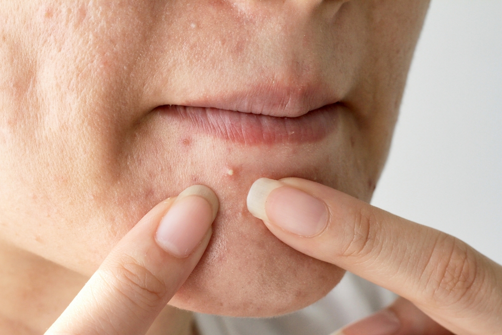 Chin Acne What It Means, Treatments and Prevention