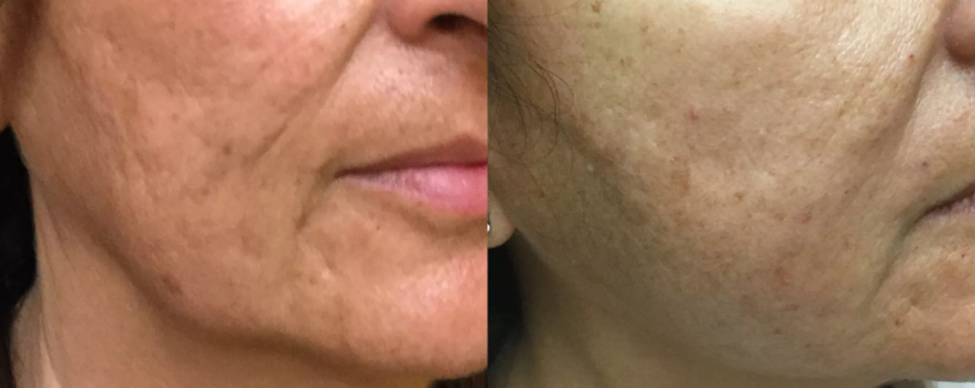 Fillers For Acne Scars: Efficacy, Before And Afters, Cost And More