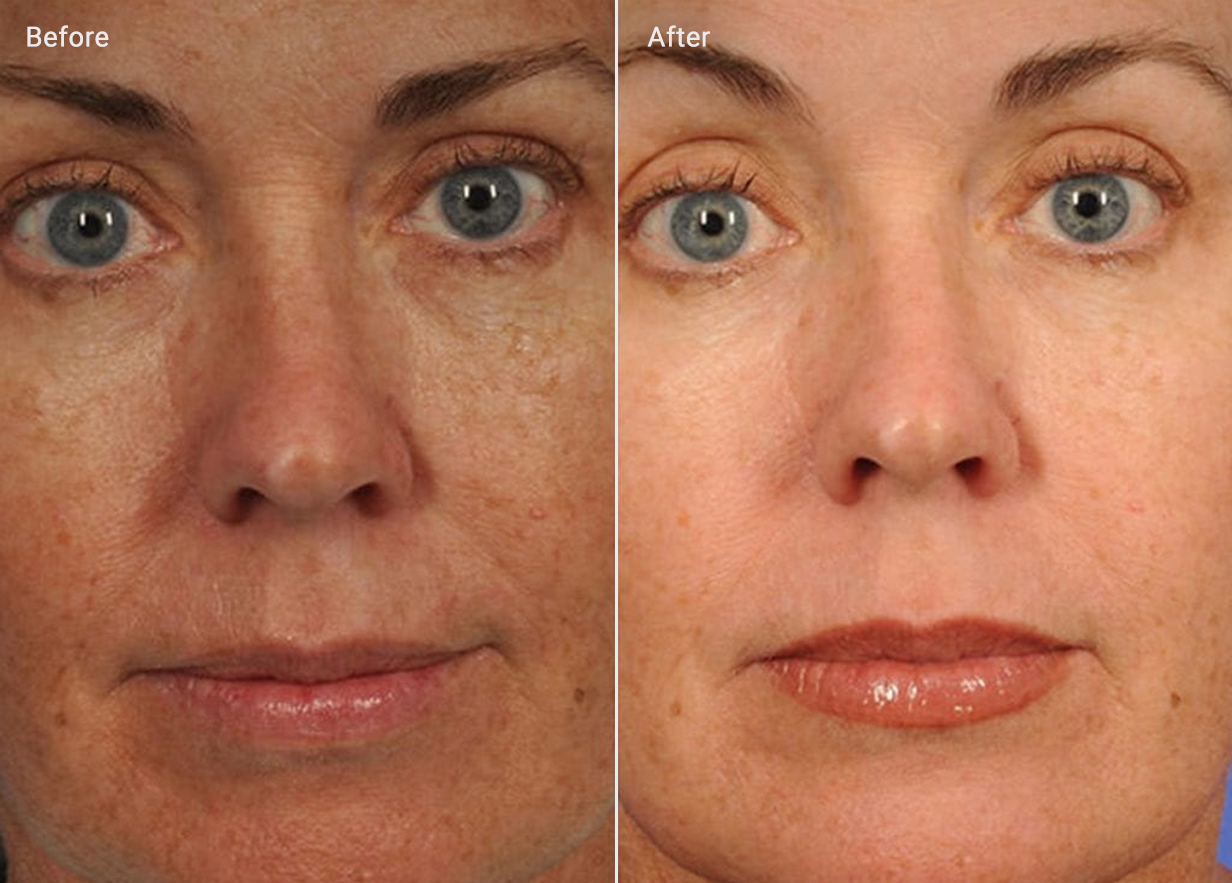 Microdermabrasion Results: Benefits, How To Maintain, Before & Afters