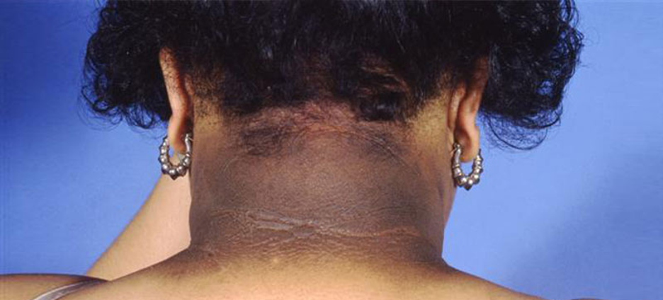 Acanthosis Nigricans: What It Is, Pictures, Causes & Treatments