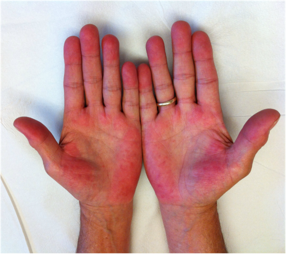 Palmar Erythema: What It Is, Causes, Pictures, Treatment