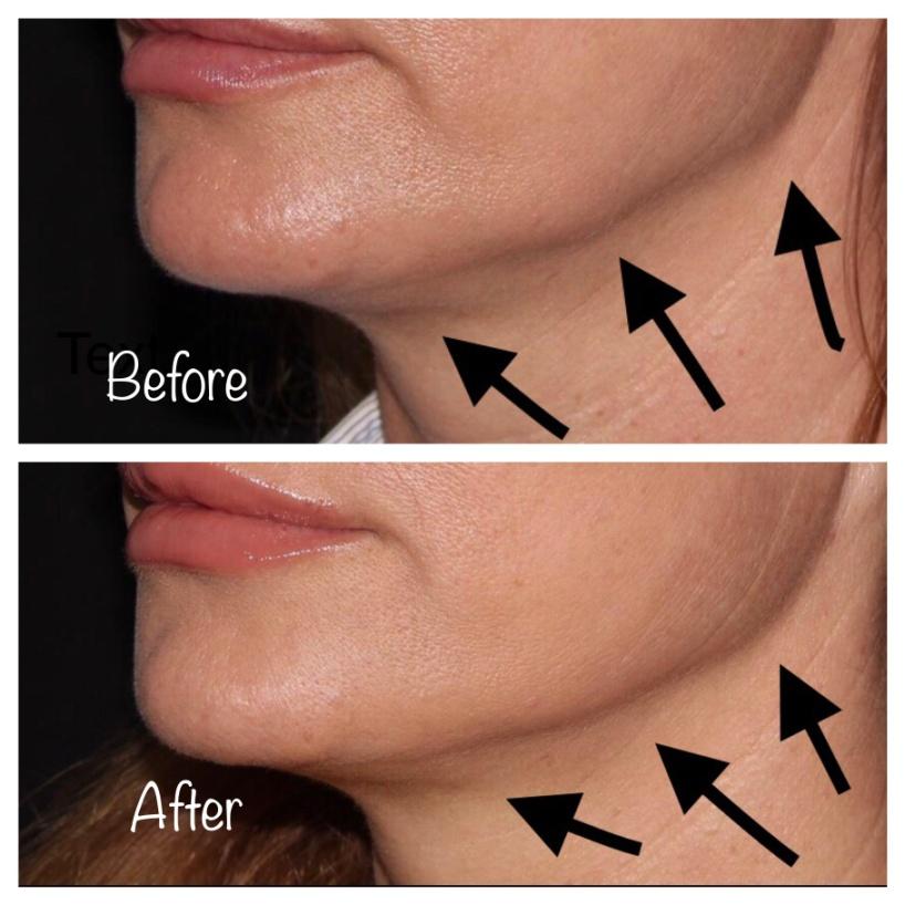 Botox For Jowls Efficacy Before Afters Side Effects Cost And More Botox For Jowls Efficacy Before Afters Side Effects Cost And More